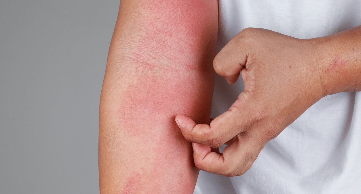 Atopowe zapalenie skóry – przyczyny, objawy, leczenie